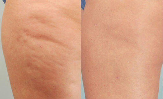 Cellulite : avant et après 10 séances de mésothérapie