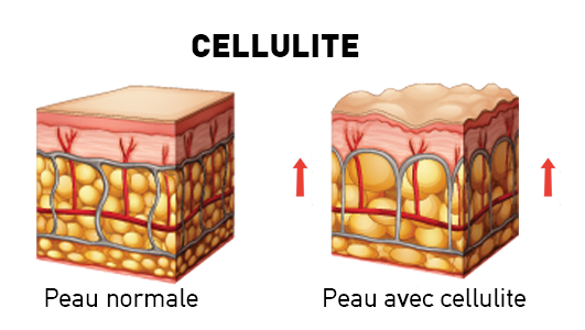 Peau normale et avec cellulite