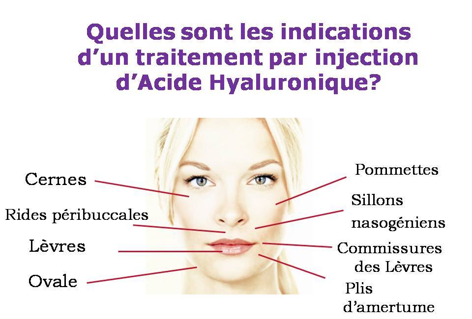 Acide hyaluronique Docteur Antonin Leclercq Beaulieu Nice
