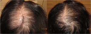 Chute des cheveux par mésothérapie : avant et après 8 séances