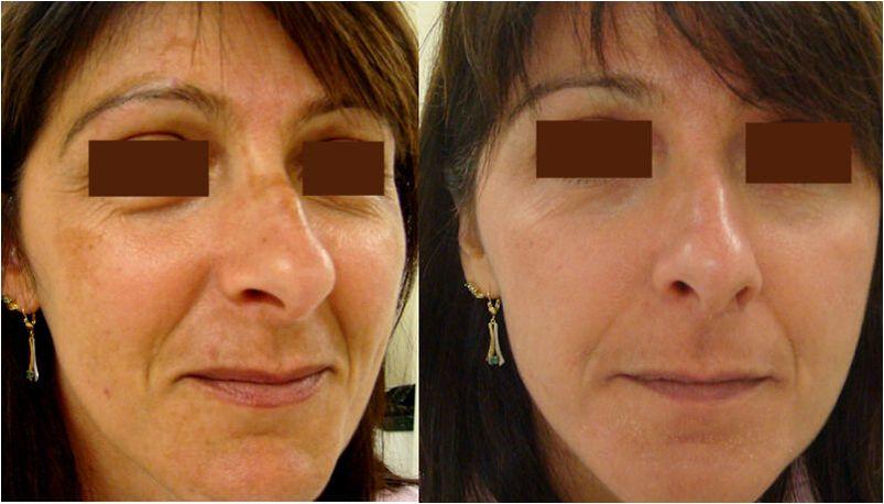 Peeling : avant séance et 15 jours après - Dr Leclercq