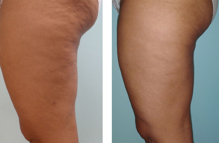 amincissement-cellulite-mesotherapie-docteur-leclercq - Dr Antonin Leclercq - MÃ©decine esthÃ©tique, Nutrition, Micronutrition, MÃ©sothÃ©rapie, Cellulite, Cryolipolyse, Beaulieu, Nice