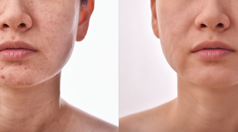 peeling acne docteur leclercq